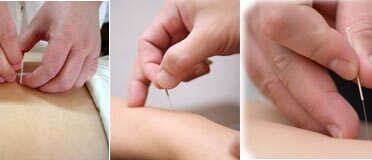 acupuncture