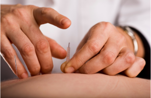 acupuncture needle