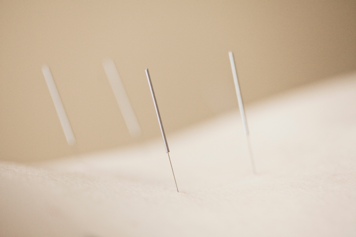 Acupuncture thin needle
